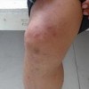 过敏性紫癜的饮食保健要如何做呢