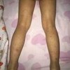 得了过敏性紫癜该吃什么不该吃什么