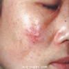 女性生殖性疱疹的症状具有什么特征呢