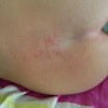 疱疹患者的发病特点
