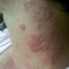 疱疹性口炎的病情发展分析