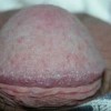 妊娠疱疹出现的重要特点介绍