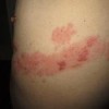疱疹患者的复发症状介绍