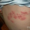 婴幼儿单纯疱疹有什么特点