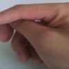 单纯疱疹发生的常见类型介绍