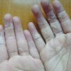 汗疱疹饮食必须多加注意有什么