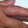 丹毒病人吃什么好呢