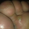 脚气和灰指甲有没有联系