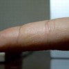 引起汗疱疹的原因都有什么呢