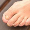 丹毒患者的饮食疗法