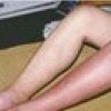 丹毒病鸡蛋可不可以吃