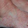 丹毒患者的食疗