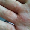 手足癣和汗疱疹的区别