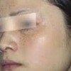 进展期雀斑要注意什么
