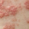 带状疱疹发生的病因有什么
