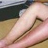 丹毒怎么治才能够治好