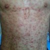 男性股腹沟淋病肉芽肿有何表现