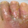 丹毒软膏治疗