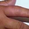 丹毒患者可以吃牛奶吗