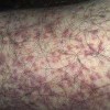 丹毒常见致病菌是什么