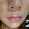 黄褐斑的防止的方式有些什么