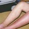 丹毒鸭子能吃吗