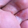 丹毒不能吃的食物
