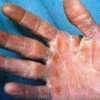 丹毒能不能吃人参
