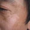 吃什么能减轻黄褐斑
