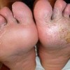 丹毒饮食必须多加注意