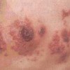 常见引起带状疱疹的有什么原因