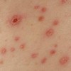 带状疱疹的五大预防措施