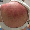 皮肌炎康复的关键是什么