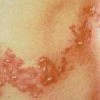 带状疱疹的原因是什么