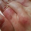 冻疮是什么其严重程度怎么划分
