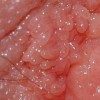 男性淋病早期的症状特征是什么