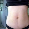 痤疮疤痕有多少种类型