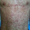 腹股沟淋巴肉芽肿常出现在什么部位