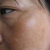 更年期女性该如何怎样的预防黄褐斑
