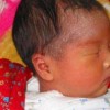 新生儿脓疱疮的防治措施