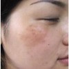 青岛能否根治花斑癣