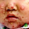 新生儿脓疱疮该怎样护理呢