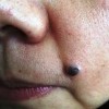晕痣性色素痣怎么治疗