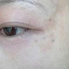 如何做好黄褐斑的预防