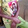多发性肌炎的生活调理
