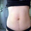 埋线双眼皮手术术后会留疤痕吗