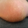 水泡型脚气治疗小偏方