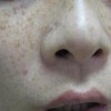 治疗黄褐斑的措施有哪些