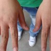 到了冬季，如何来预防冻疮