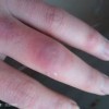 冻疮怎样的预防